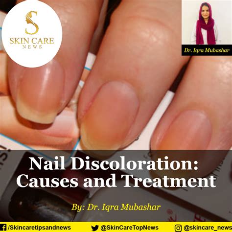 Nail Discoloration Causes And Treatment Skincare News