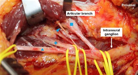 Intraoperative Clinical Photographs Of Case 2 Showing The Left Common