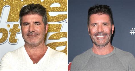 What Did Simon Cowell Do To His Face