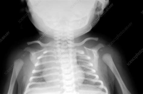 Young Child X Ray Stock Image P1160844 Science Photo Library