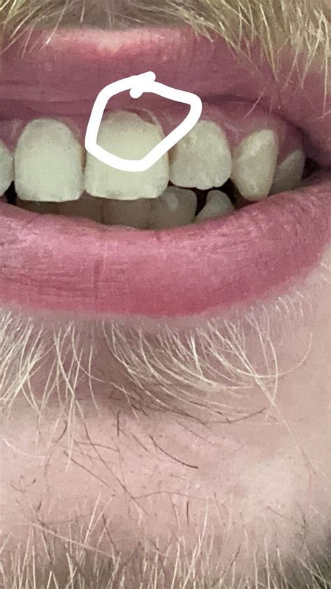 Cracked Front Tooth Right On Gumline Raskadentist