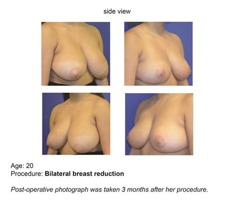 Breast Reduction UF Health Plastic Surgery And Aesthetics Center UF