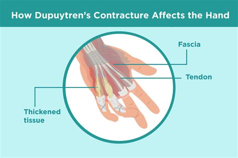 Dupuytrens Contracture Treatment Surgery Getting Relief