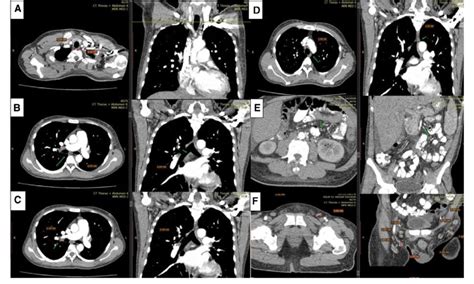 Multiple Lymphadenopathies Detected From Thorax And Abdomen Ct Scans A