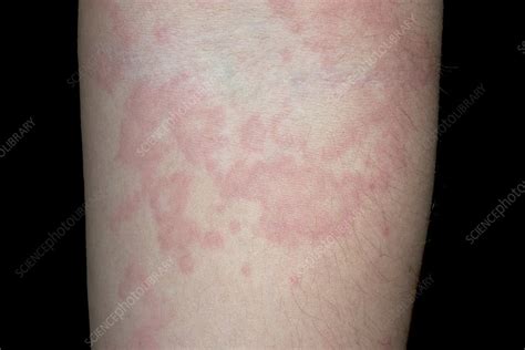 Urticaria Stock Image C0234298 Science Photo Library