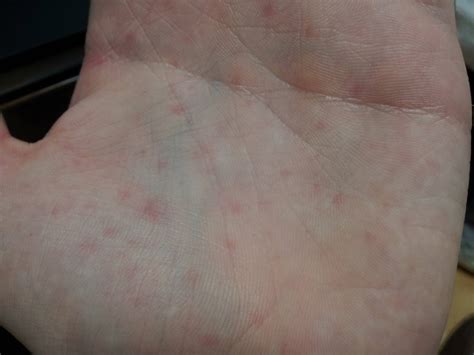 Red Spots On Palms Of Hand Pictures Photos