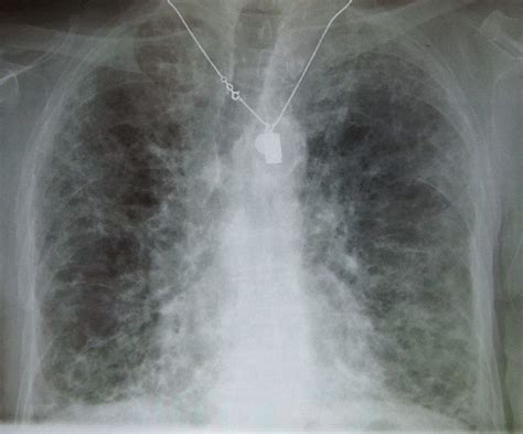 Dark Lung Spots On X Ray Hubpages