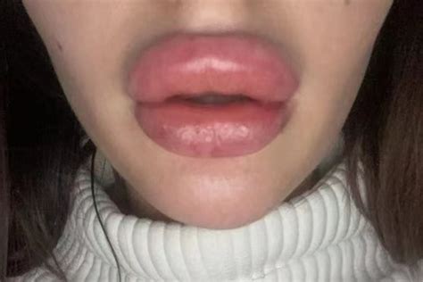 Lip Injections Gone Wrong And How To Avoid