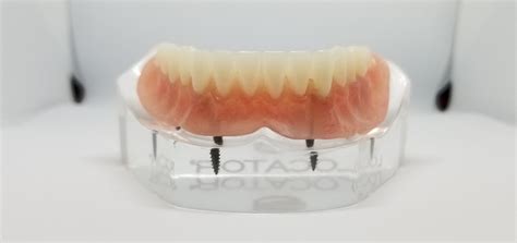 Cost Of Dental Implants — Memphis Dentures And Implants