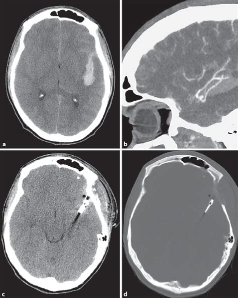 Ct Scan Showing A Subarachnoid Hemorrhage A And A Ct Angiography