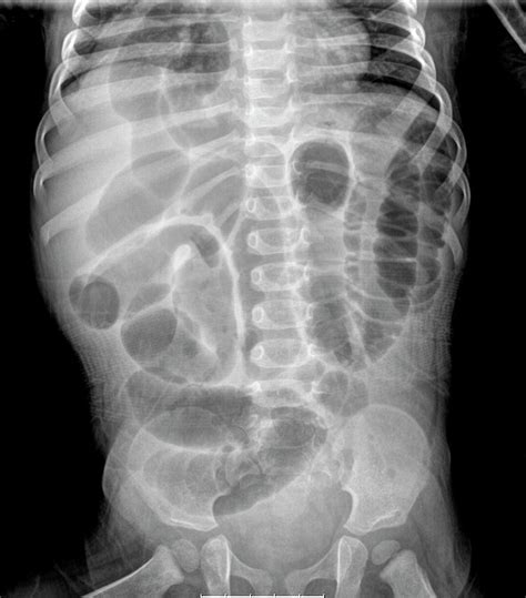 Diaphragmatic Hernia Photograph By Photostock Israelscience Photo