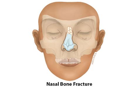 Nasal Bone Fracture Pediatric X Ray Nasal Bone Fracture Portal