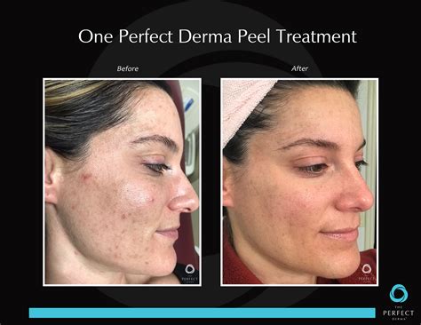 The Perfect Derma Peel In Mission Valley Ca Confident Complexion