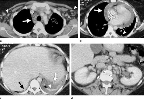 Systemic Multicentric Hyaline Vascular Castleman Disease Mimicking