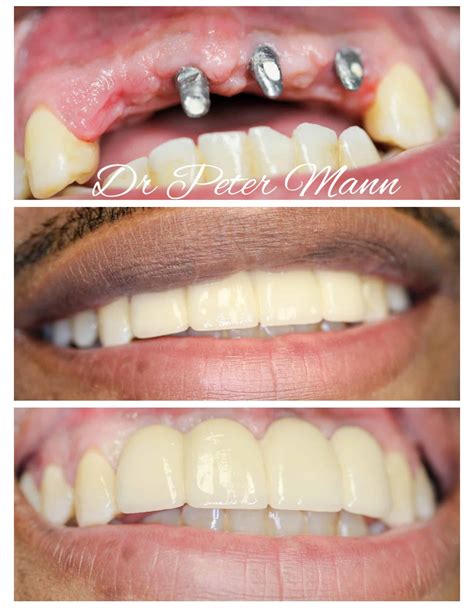 Dental Implants Before And After Photos Nyc Dentist