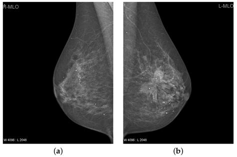 Applied Sciences Free Full Text Ttcnn A Breast Cancer Detection And Classification Towards