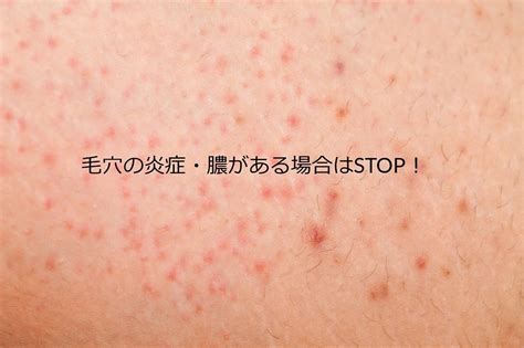 剃刀 負け 治す | カミソリ負けに効く市販薬おすすめ6選：2019年 ...