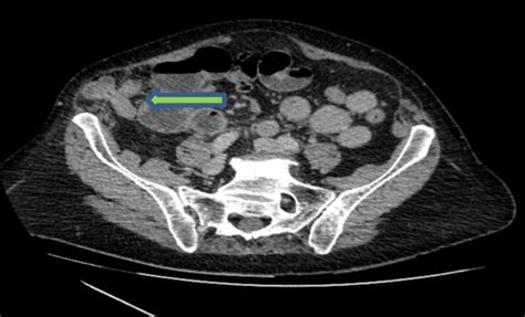 Cross Section Of Ct Scan Showing Richters Type Of Hernia Download