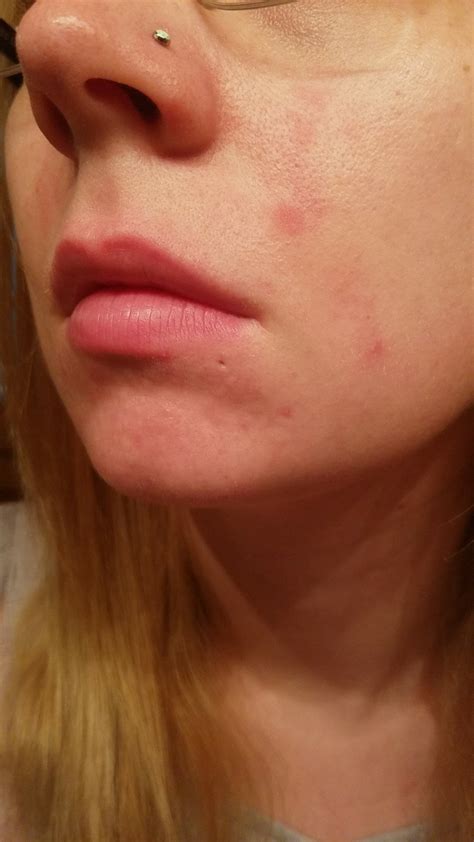 Dry Itchy Red And Sometimes Burning Patches Appeared On Face Dermatology