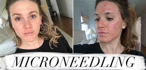 Microneedling- Good OR Harmful? Comprehensive Report - Cheaperks