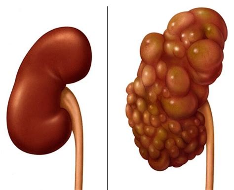 Polycystic Kidney Disease Health And Hopes
