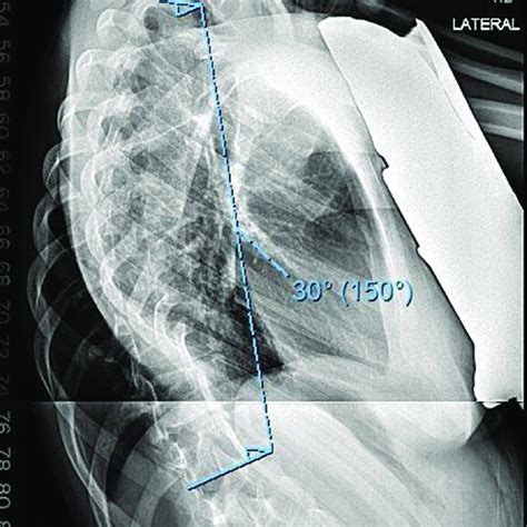 Example Of Thoracic Kyphosis Measurement T2 To T12 On Preoperative