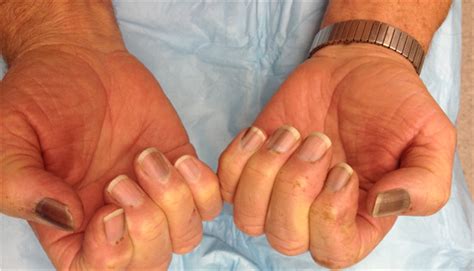 Derm Dx Hyperpigmentation On Fingers Fingernails And Lips Clinical
