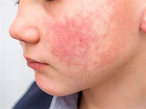 Common Childhood Skin Rashes With Pictures What Rash Is This Which