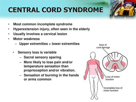 Central Cord Syndrome Definition Causes Symptoms Prog