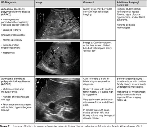 Figure 1 From Imaging Of Kidney Cysts And Cystic Kidney Diseases In