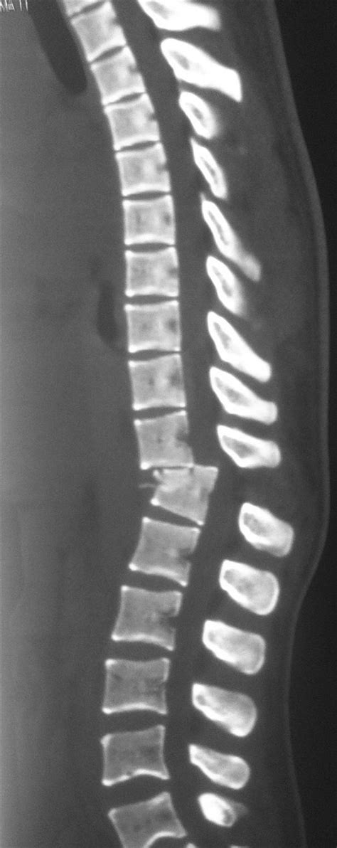 Thoracolumbar Fracture Dislocation Spine Orthobullets