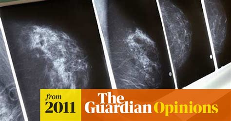 Breast Screening Should Be Scrapped Michael Baum The Guardian