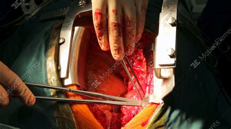 Beating Human Heart Close Up In Opened Chest During The Surgery Stock