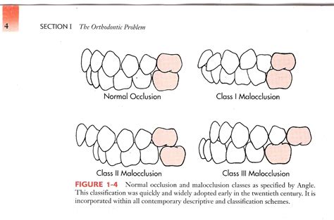 Occlusion The Contact Between Your Teeth Steve Gallik