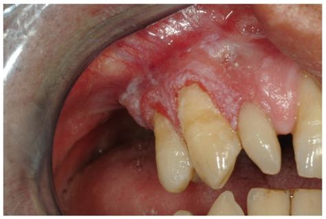 Clinical View Of A Squamous Cell Carcinoma On The Right Maxillary