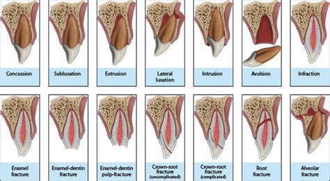 Dental Trauma And Tooth Fracture Wow Dental