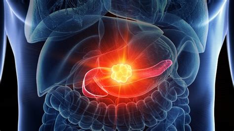 Neoadjuvant Chemo Ups Survival In Pancreatic Cancer