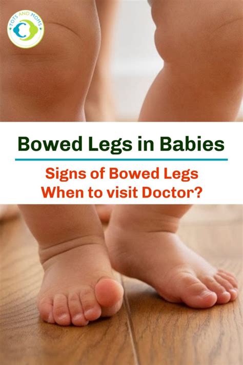 Bowed Legs Signs Of Bowed Legs When To Visit The Doctor With Video