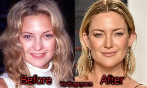 Kate Hudson Plastic Surgery Before And After Nose Boob Job Pictures
