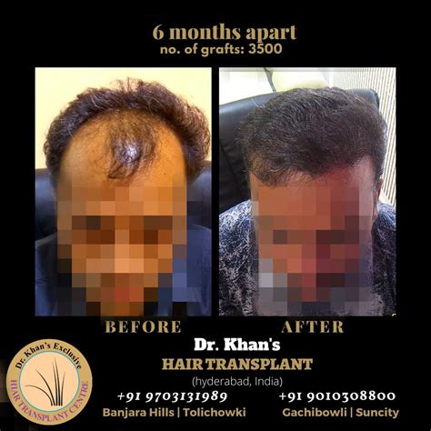 Aggregate 62 Dr Khan S Hair Transplant In Eteachers