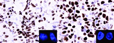 Myc Ihc In Two Diffuse Large B Cell Lymphomas Dlbcl A Dlbcl Case