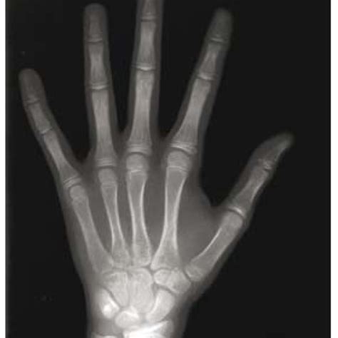 A Posteroanterior Hand Wrist Radiograph From A 10year Old Girl Equal