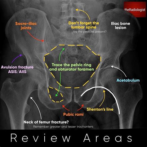 Pelvic Bone X Ray