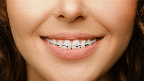 Invisible Braces For Adults