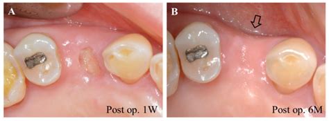 Pharmaceuticals Free Full Text Periodontal Wound Healing And Tissue