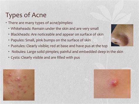 Ppt Acne Powerpoint Presentation Free Download Id1938167
