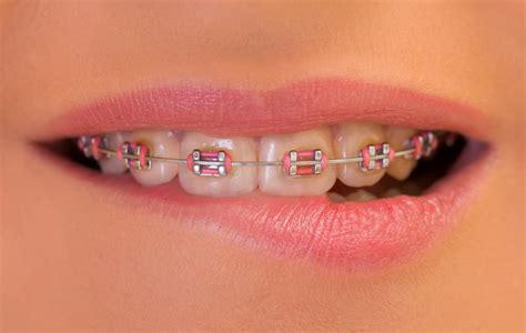 Your Braces From Start To Finish Belmar Orthodontics