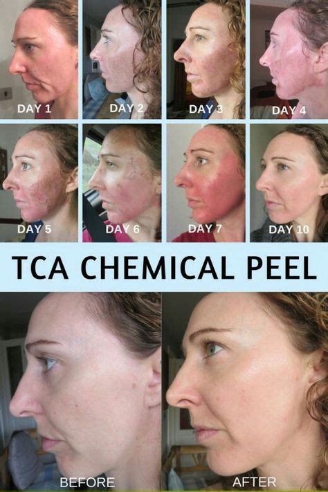 Tca Peel On Skin Cancer Hot Sex Picture