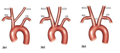 Cureus Anatomical Variations In Aortic Arch Branching Pattern A