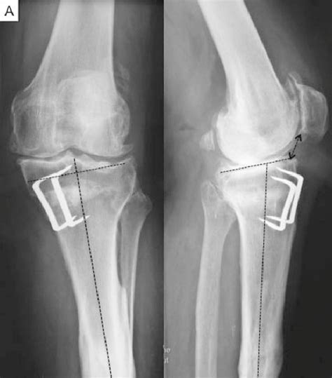 Lateral Oa Following An Opening Wedge Hto The Tibial Slope Is